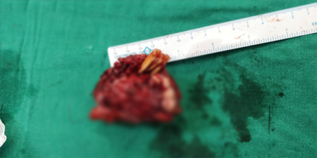 Jaw Bone Cancer Treatment in India
